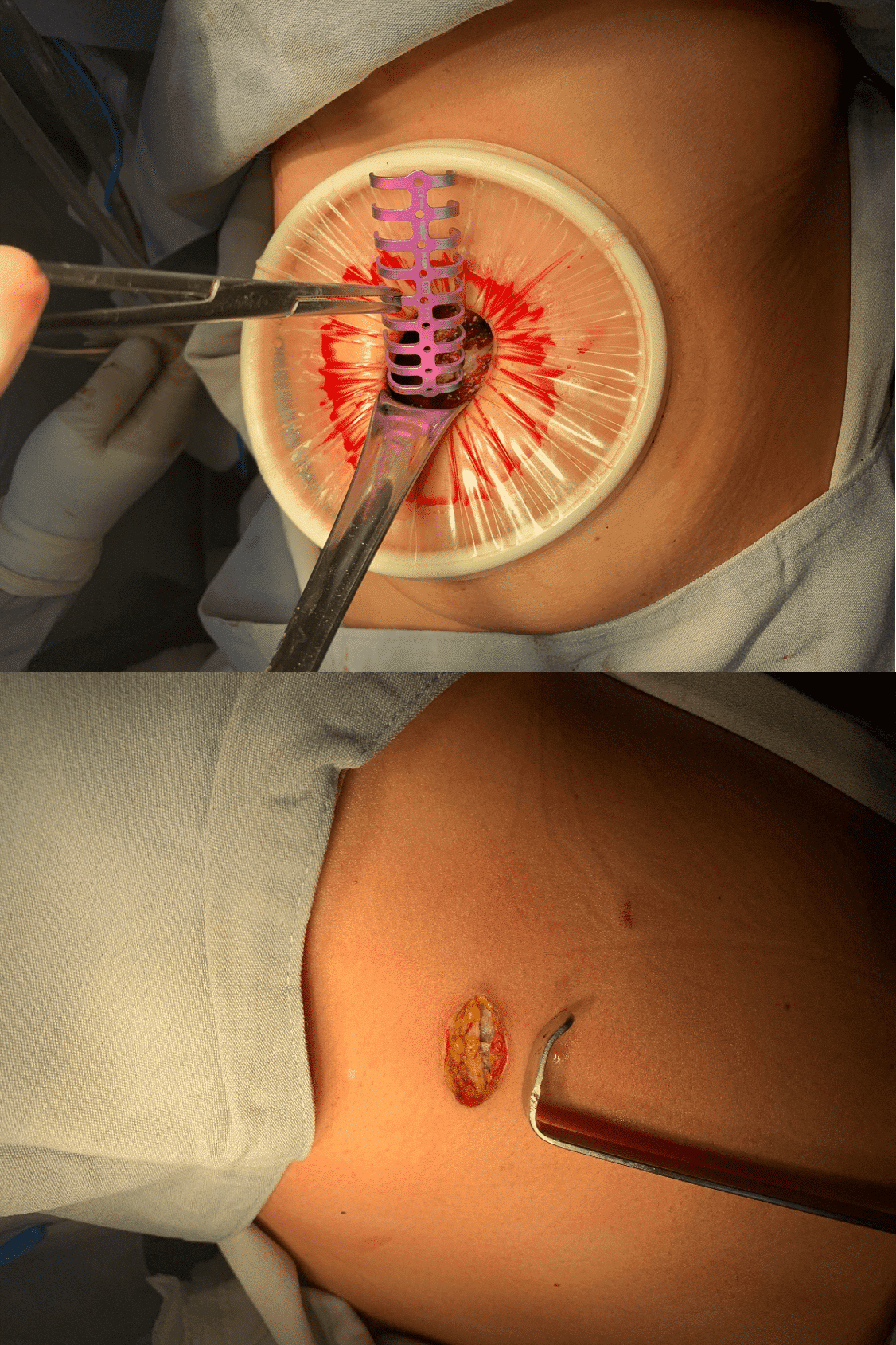 Fijación de fracturas costales por mínima invasión